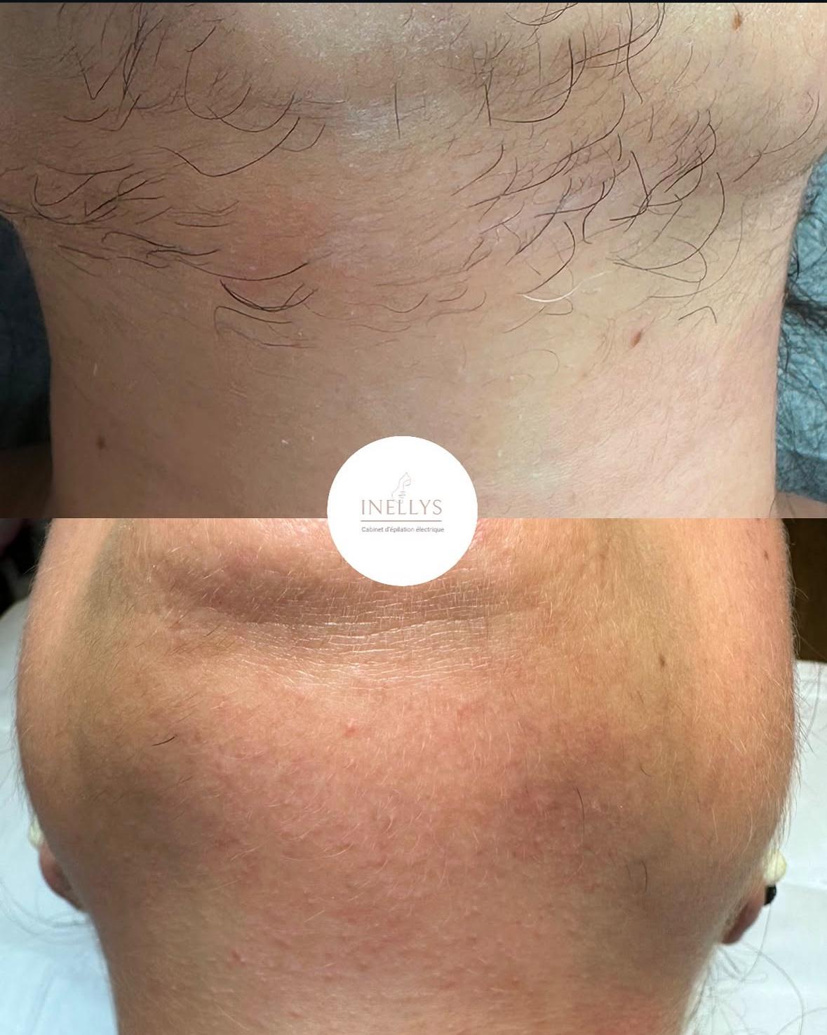 epilation electrolyse à villepinte en ile de france inellys