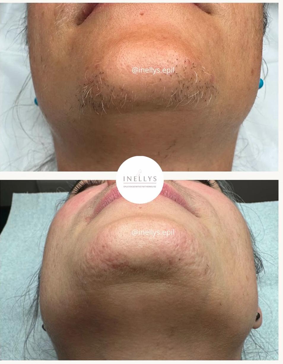 epilation thermolyse villepinte